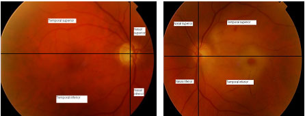 Fondo de ojo  La exploración del fondo de ojo u oftalmoscopia consiste en  la visualización a través de la pupila y de los medios  Instagram